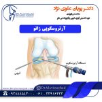 آرتروسکوپی زانو