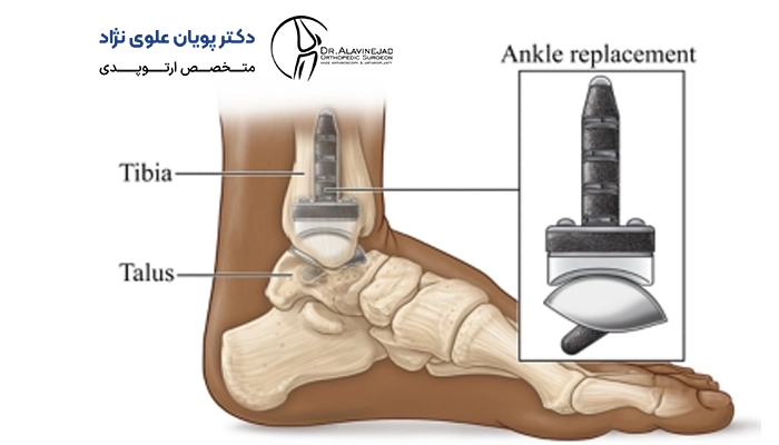 مراحل انجام آرتروپلاستی مچ پا