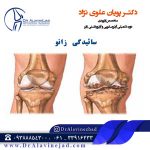 ساییدگی زانو