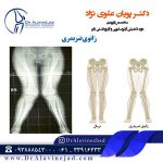 زانوی ضربدری