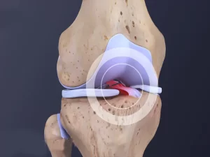 پارگی رباط صلیبی