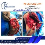 عکس در رفتگی مفصل آرنج