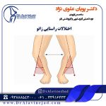 اختلالات راستایی زانو