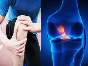 پارگی و بازسازی رباط صلیبی قدامی (ACL)