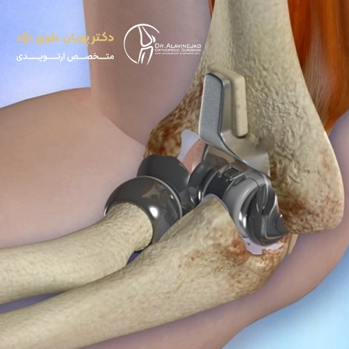 آرتروپلاستی آرنج