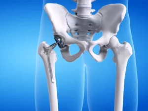 آرتروپلاستی مفصل ران