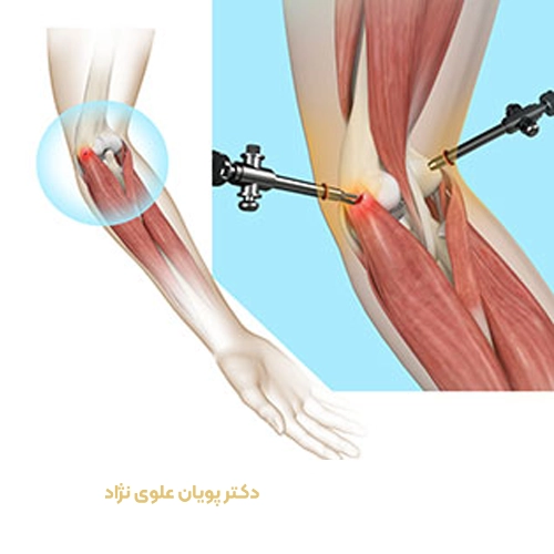 جراحی آرتروپلاستی آرنج