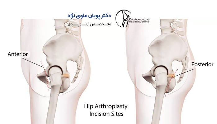 نحوه انجام آرتروپلاستی مفصل ران