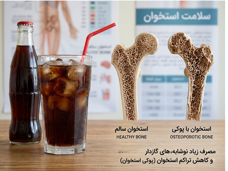 نوشابه چه تاثیری در پوکی استخوان دارد؟